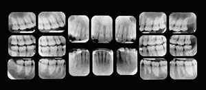 teeth x-ray